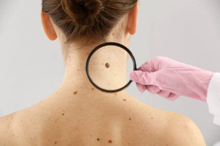Mole Removal by Dermatologist: Step-by-Step Process
